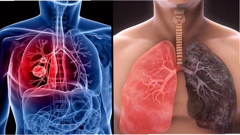 Hơi thở khò khè là dấu hiệu sắp chết của người bị ung thư phổi