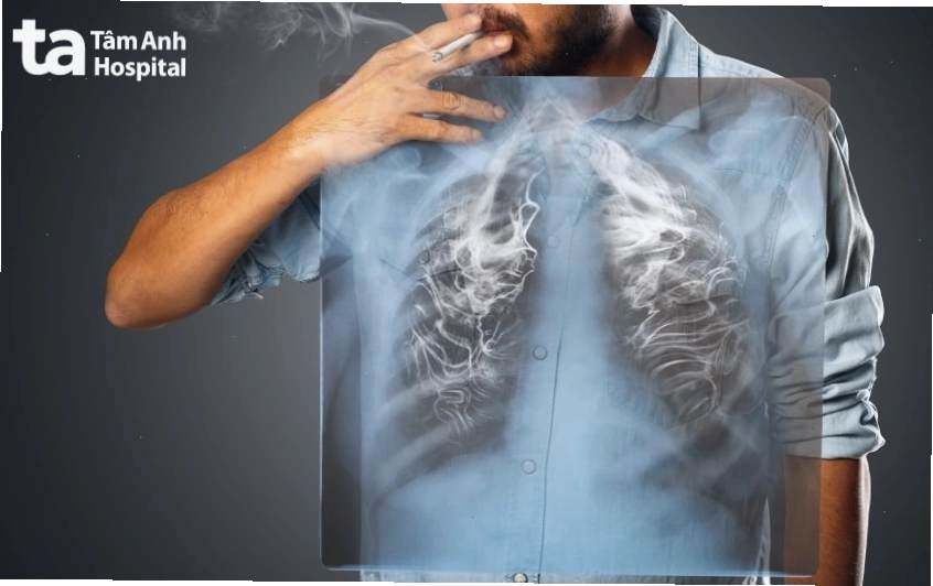 Hút thuốc có nguy cơ ung thư phổi