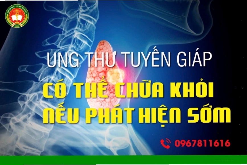 Khả năng chữa khỏi ung thư tuyến giáp rất khả quan khi phát hiện sớm