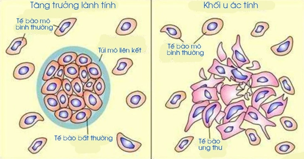 Khối U Ác Tính Là Gì? Đặc Điểm, Nguyên Nhân và Cách Nhận Biết Sớm