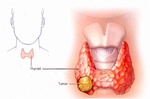 Khối u ung thư tuyến giáp xâm lấn vào các mô xung quanh