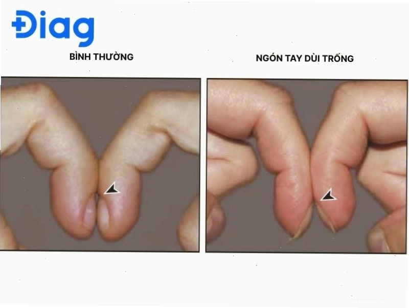 Kiểm tra hiện tượng ngón tay dùi trống (clubbing test) liên quan đến các vấn đề hô hấp