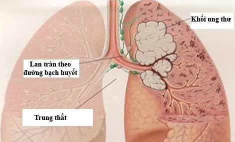 Lập kế hoạch chăm sóc bệnh nhân ung thư phổi toàn diện và hiệu quả