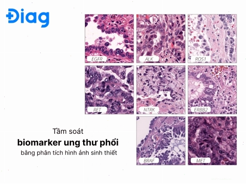 Marker ung thư phổi là các chất sinh học liên quan đến sự phát triển hoặc hiện diện của khối u phổi