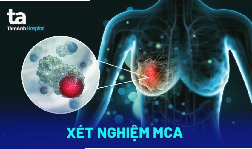 MCA là một dấu ấn ung thư có thể liên quan đến ung thư vú