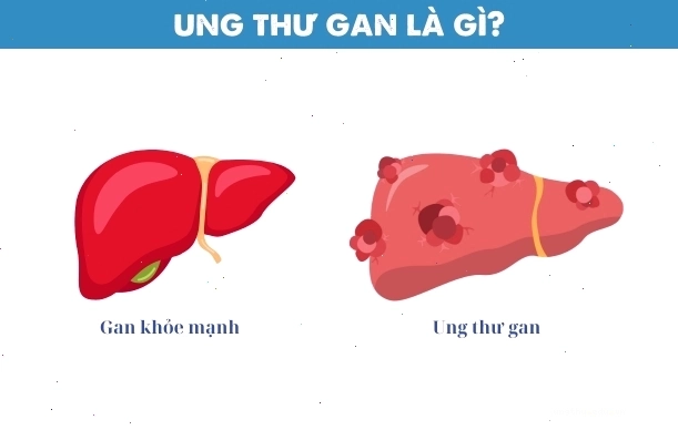 Minh họa các giai đoạn phát triển của ung thư gan