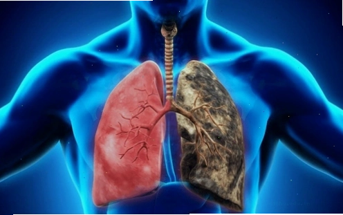 Minh họa các triệu chứng ung thư phổi ở giai đoạn muộn