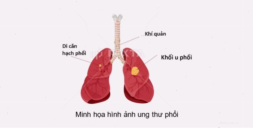 Minh họa cấu trúc phổi và khối u ung thư