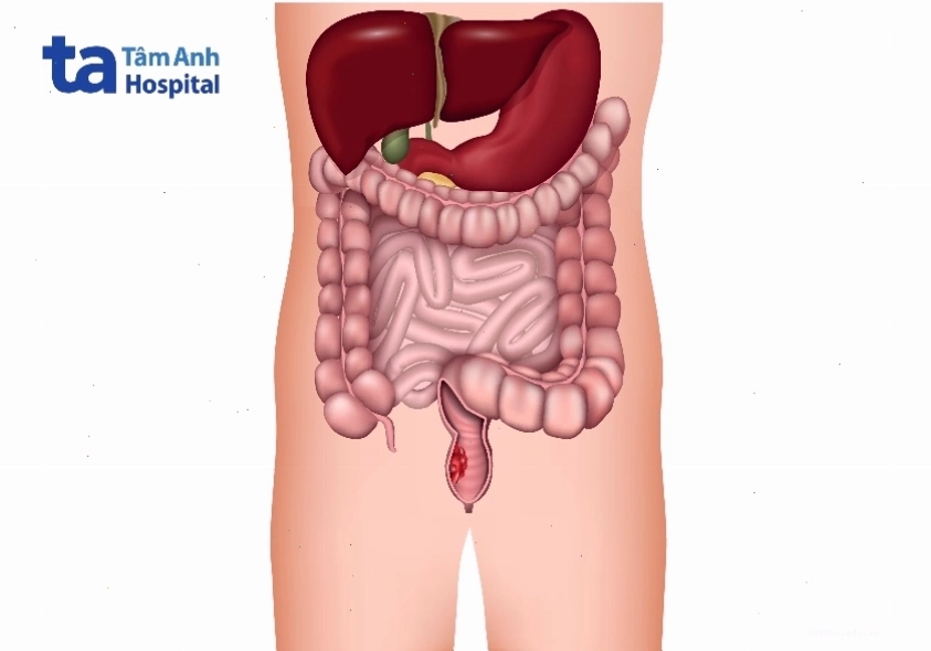 Minh họa hệ tiêu hóa với vị trí đại trực tràng