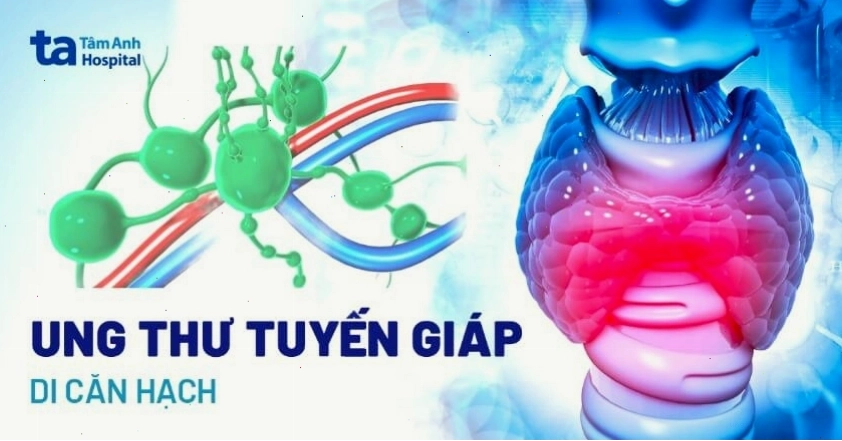 Minh họa ung thư tuyến giáp di căn đến các hạch bạch huyết vùng cổ