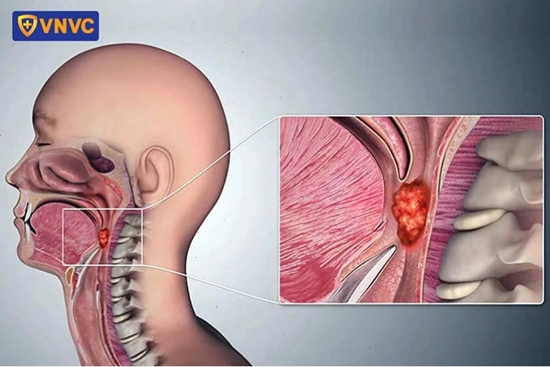 Mô hình giải phẫu ung thư vòm họng