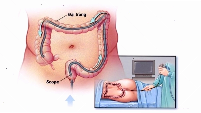 Nội soi đại trực tràng giúp bác sĩ quan sát chi tiết niêm mạc đại tràng
