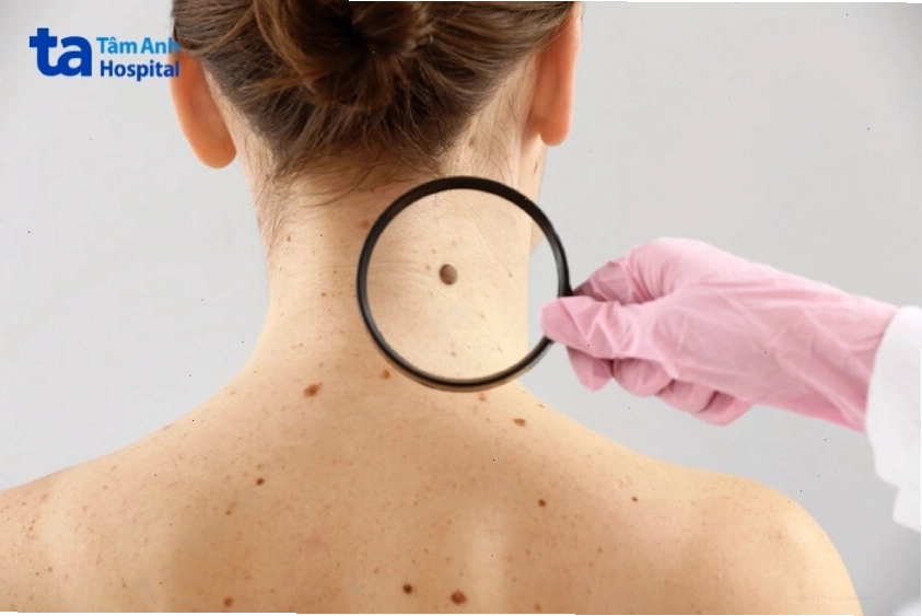 Nốt ruồi ung thư hắc tố có kích thước lớn và màu đen sẫm
