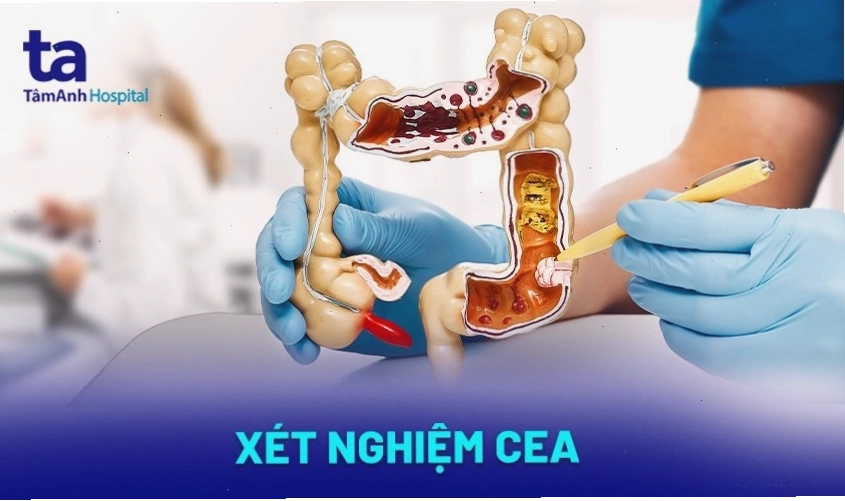 Ống nghiệm chứa mẫu máu để xét nghiệm PSA