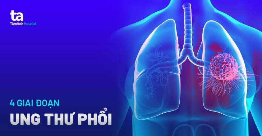 Phân độ ung thư phổi TNM: Hướng dẫn chi tiết và cập nhật mới nhất