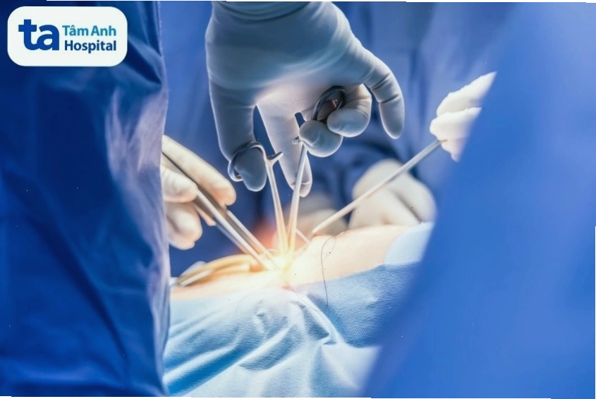 Phẫu thuật điều trị ung thư phổi di căn xương