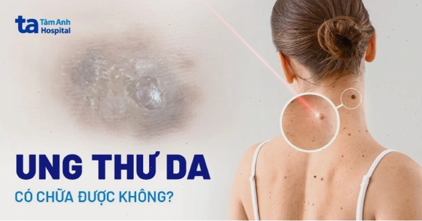 Phẫu thuật ung thư da, loại bỏ khối u ác tính