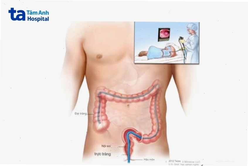 Phương pháp nội soi tầm soát ung thư đại trực tràng