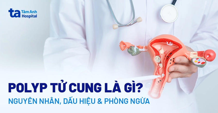 Polyp cổ tử cung có gây ung thư không? Giải đáp chi tiết từ chuyên gia