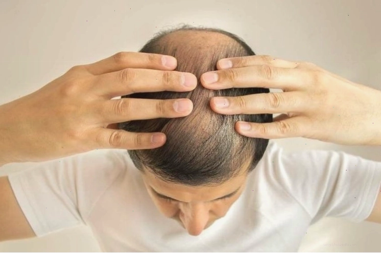 Quá trình điều trị ung thư Kaposi đòi hỏi sự theo dõi y tế chặt chẽ