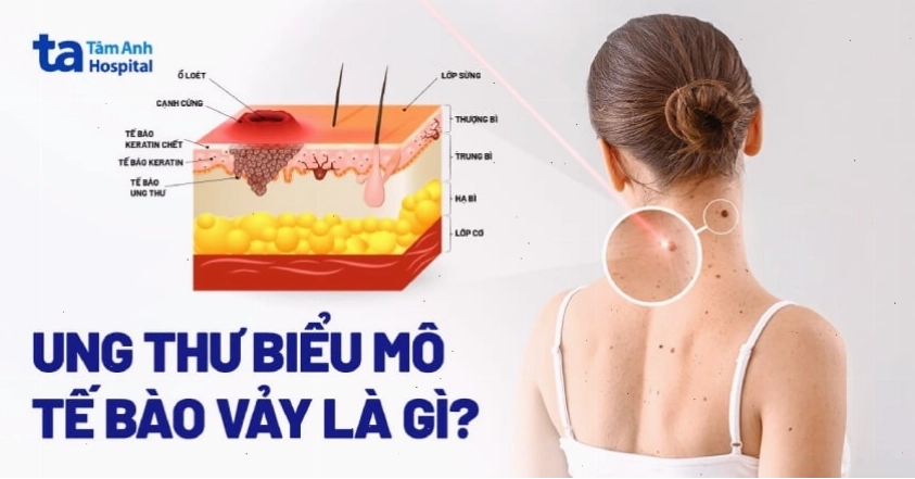 Quy trình điều trị ung thư biểu mô tế bào vảy
