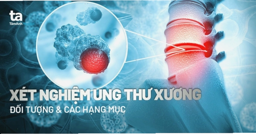 Tầm soát ung thư xương giúp phát hiện bệnh sớm