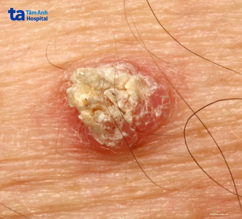 Tổn thương sần sùi nghi ngờ ung thư biểu mô tế bào vảy