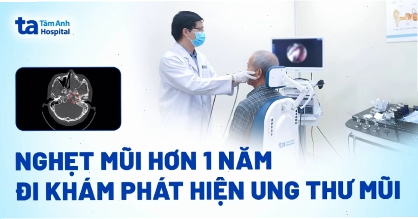 Triệu chứng nghẹt mũi kéo dài có thể là dấu hiệu sớm của ung thư mũi