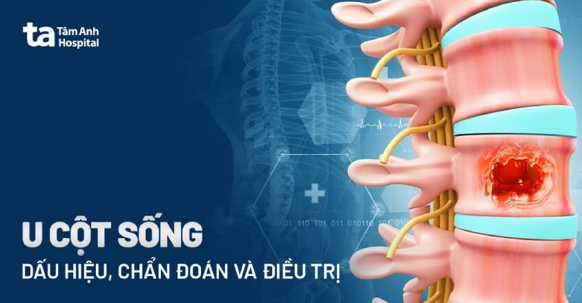 Triệu chứng ung thư cột sống: Dấu hiệu nhận biết và chẩn đoán sớm