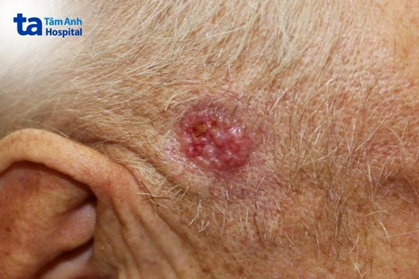Triệu chứng ung thư da đầu và những dấu hiệu cần nhận biết sớm