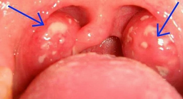 Ung thư amidan có chết không: Giải đáp chi tiết và các yếu tố ảnh hưởng