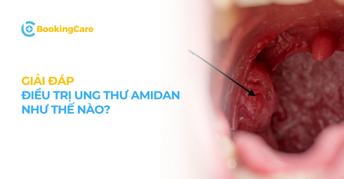 Ung thư amidan giai đoạn cuối: Hiểu rõ, đối mặt và vượt qua