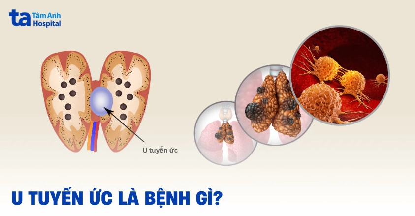 Ung thư biểu mô tuyến ức: Nhận biết triệu chứng và phương pháp điều trị