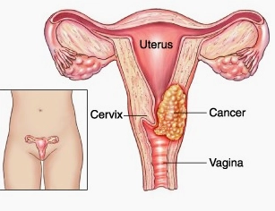 Ung thư cổ tử cung tiếng Anh là gì và cách phòng ngừa hiệu quả