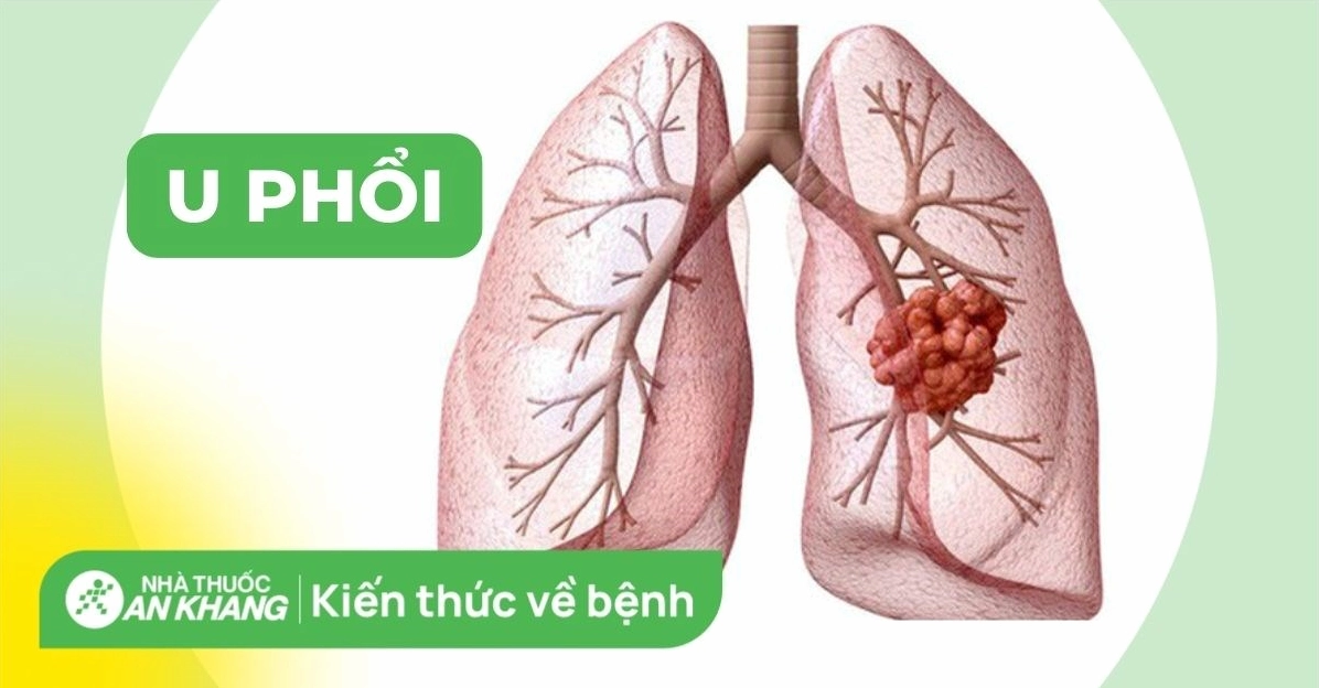 Ung thư cuống phổi: Nguyên nhân, dấu hiệu và phương pháp điều trị