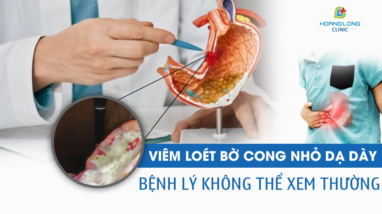 Ung thư dạ dày bờ cong nhỏ những điều cần biết