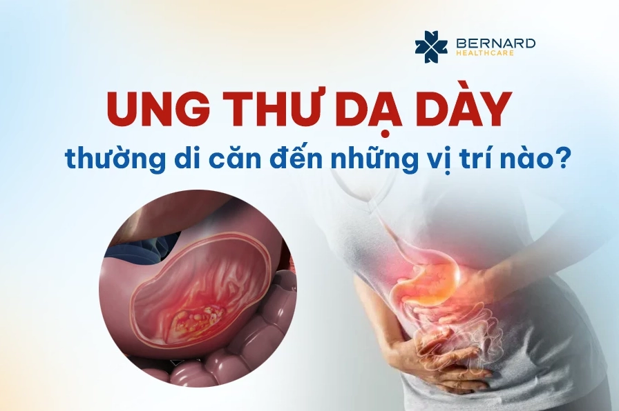 Ung thư dạ dày di căn hạch thượng đòn: Dấu hiệu, chẩn đoán và phương pháp điều trị