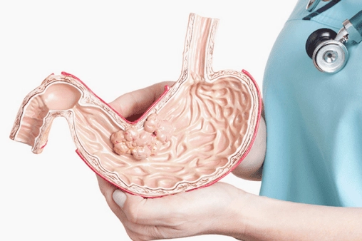 Ung thư dạ dày gây khó thở: Triệu chứng, nguyên nhân và cách giảm nhẹ