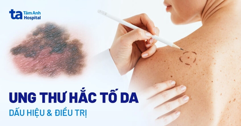 Ung thư da melanoma: Dấu hiệu, nguyên nhân và cách chẩn đoán sớm