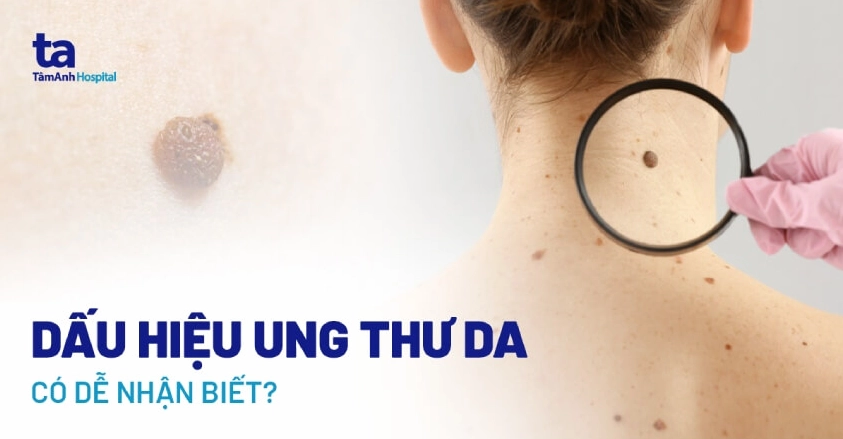 Ung thư da như thế nào: Nguyên nhân, dấu hiệu và phòng ngừa