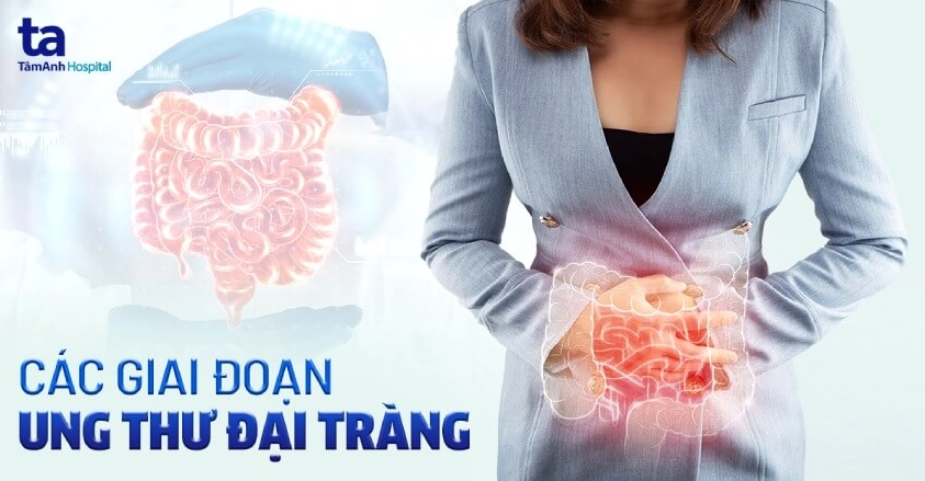 Ung thư đại tràng có mấy giai đoạn: Phân loại chi tiết từ 0 đến IV