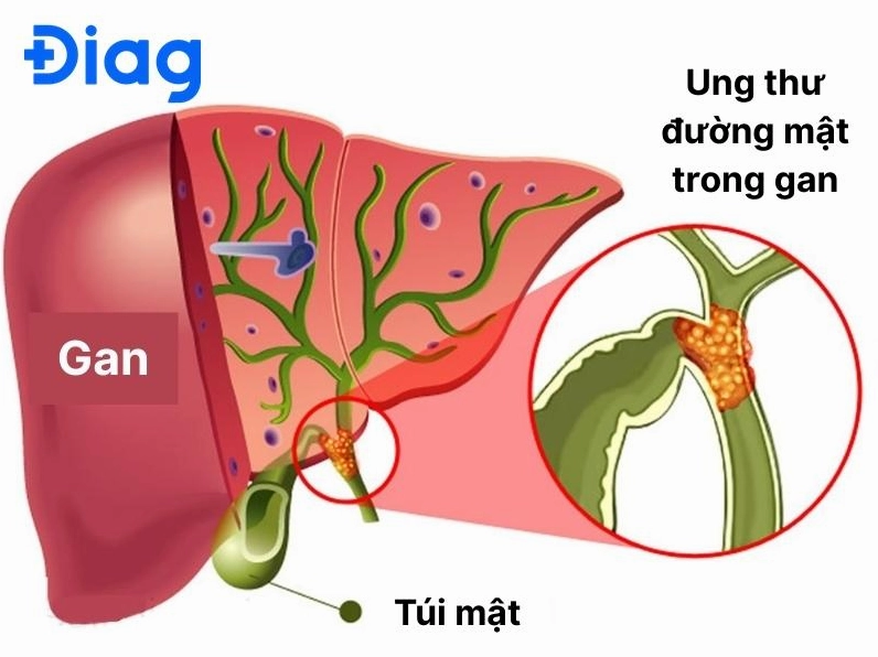 Ung thư đường mật trong gan sống được bao lâu và các yếu tố ảnh hưởng