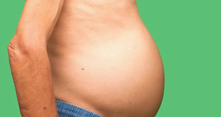 Ung thư gan cổ trướng: Nguyên nhân, triệu chứng và cách điều trị
