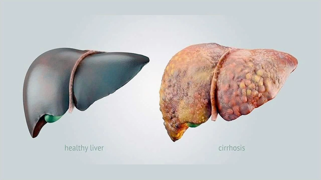 Ung thư gan giai đoạn cuối sống được bao lâu và các yếu tố ảnh hưởng