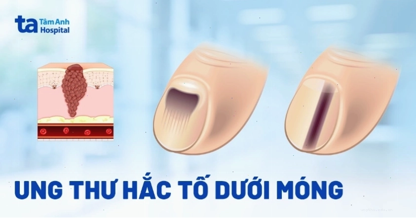Ung thư hắc tố dưới móng với các triệu chứng như nứt, biến dạng móng