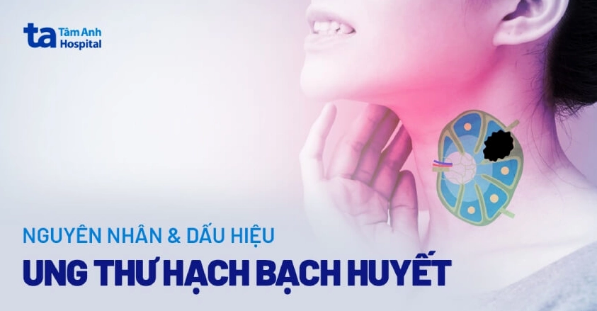 Ung thư hạch bạch cầu dấu hiệu nhận biết và nguyên nhân bệnh