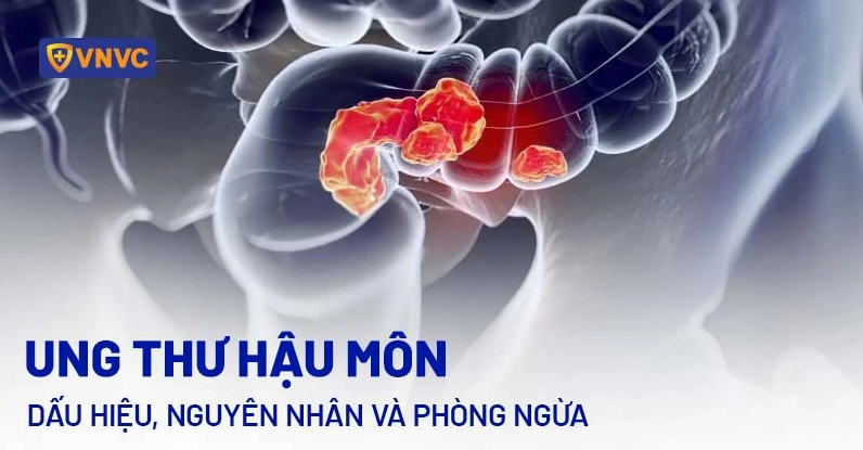 Ung thư hậu môn sống được bao lâu? Các giai đoạn và tiên lượng