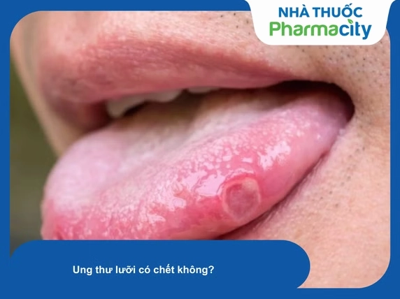 Ung thư lưỡi có chết không? Chẩn đoán, giai đoạn và tiên lượng