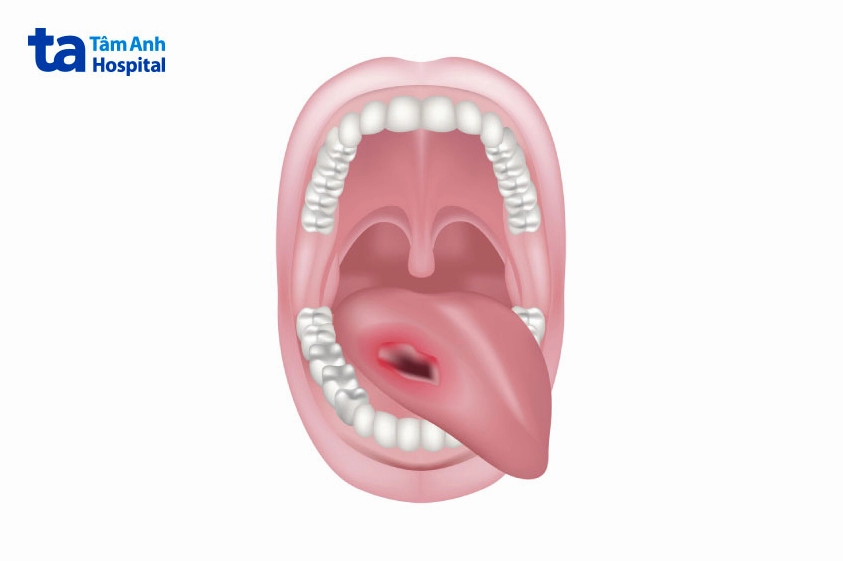 Ung thư lưỡi có chữa khỏi được không? Dấu hiệu và yếu tố nguy cơ
