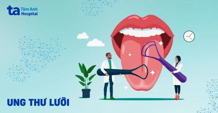 Ung thư lưỡi có nguy hiểm không? Dấu hiệu và cách nhận biết sớm